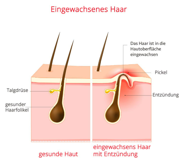 eingewachsenes-haar-intimbereich-2.png