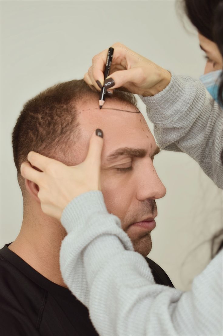 haartransplantation-kosten.jpg