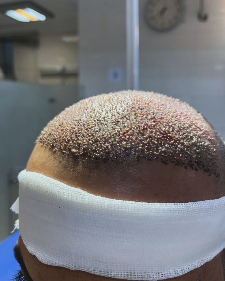 Afro-Haartransplantation in Antalya