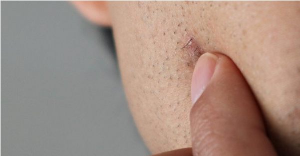 Eingewachsenes Haar & Intimbereich: Was hilft gegen eingewachsene Haare wirklich?