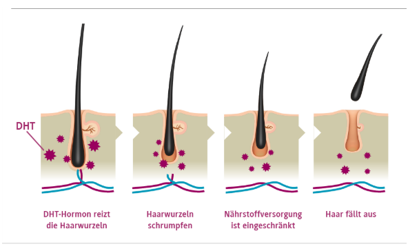 Natürliche DHT Blocker: Wie Dihydrotestosteron Haarausfall verursacht und wie man ihn stoppt