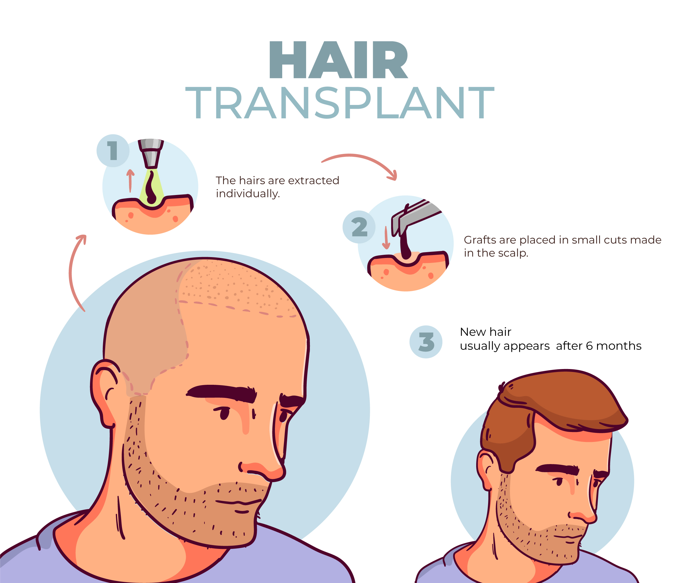 hair-transplant-alanya.jpg