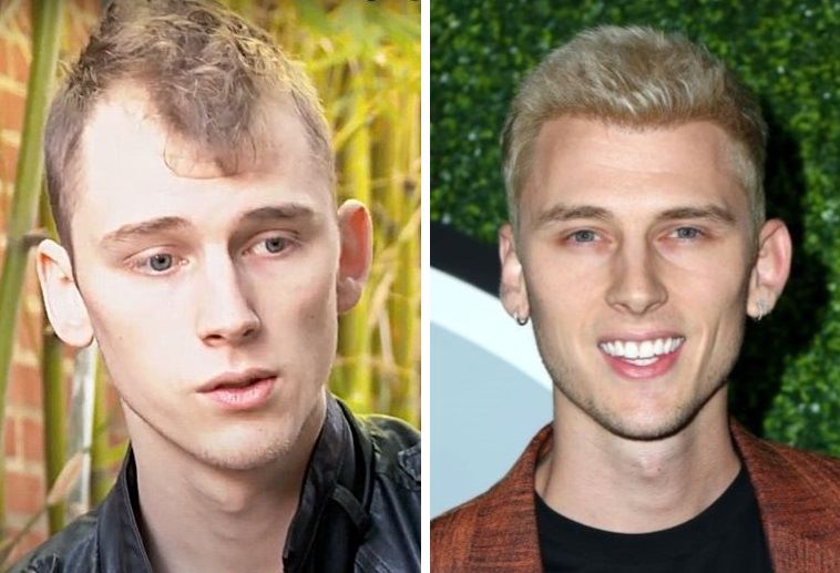 mgk-hair-transplant.jpg