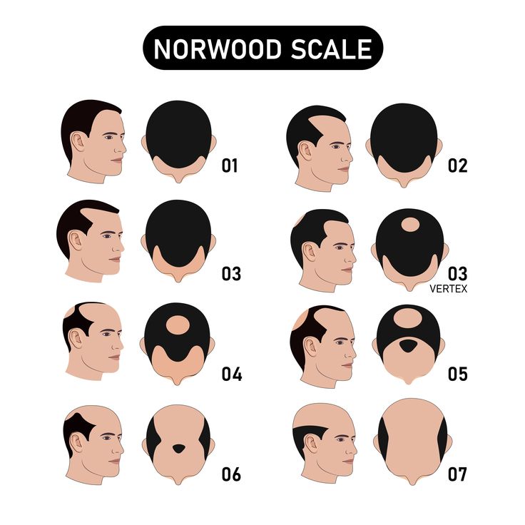 norwood-scale-stages-1-7.jpg