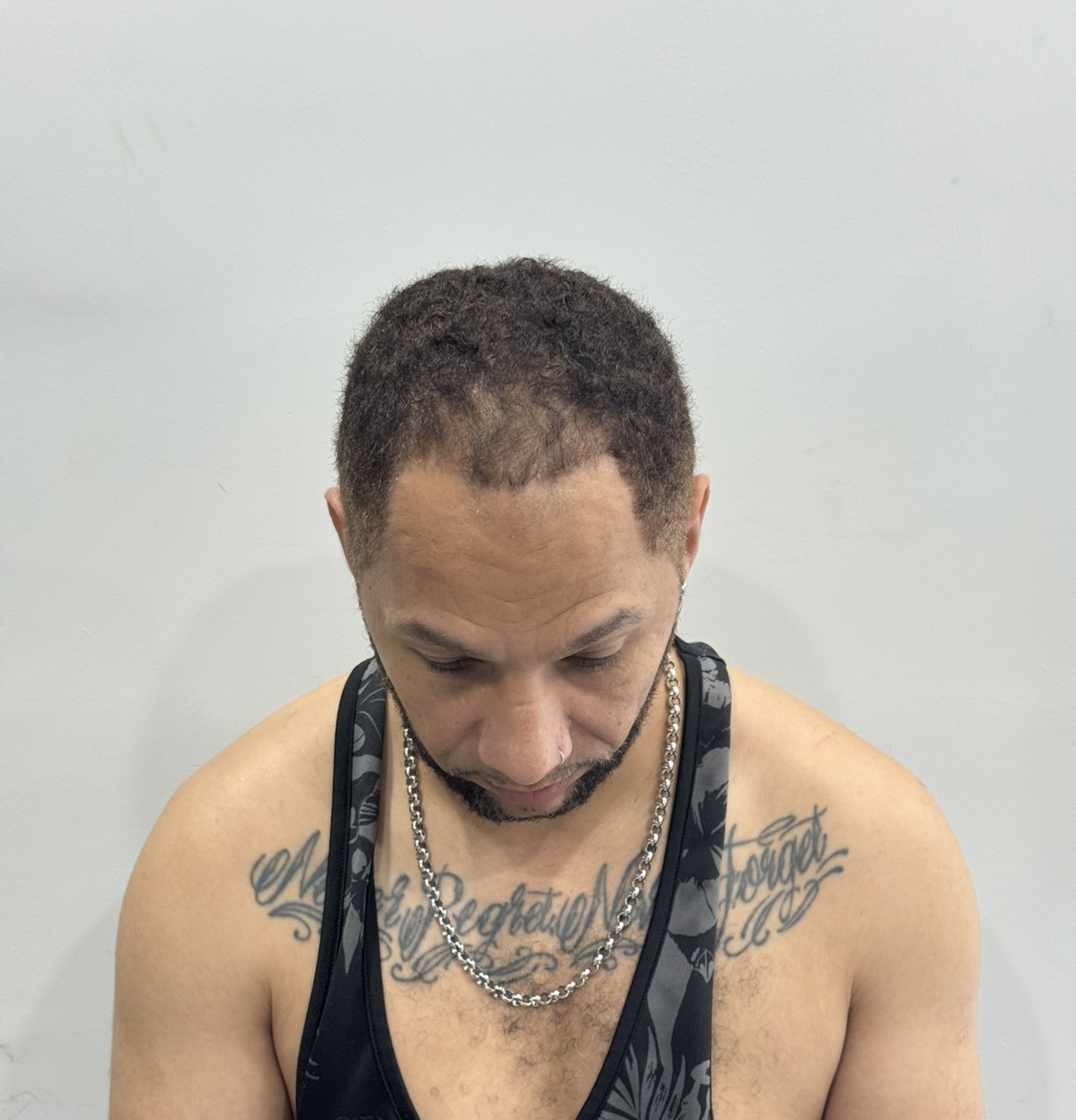 донорская зона и извлечение графтов при Afro пересадке волос