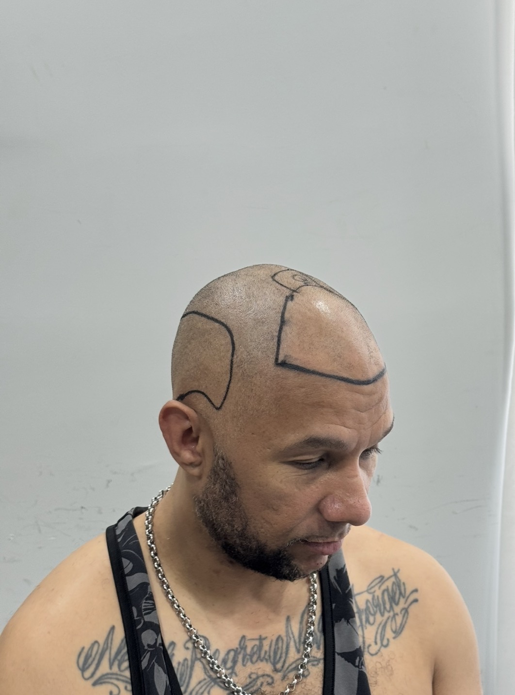 Afro пересадка волос в Анталье фото 3
