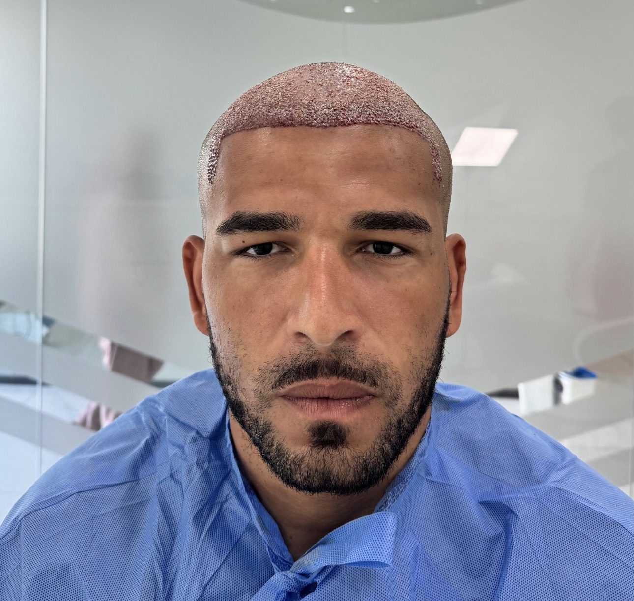 Afro пересадка волос в Haarex Clinic Antalya