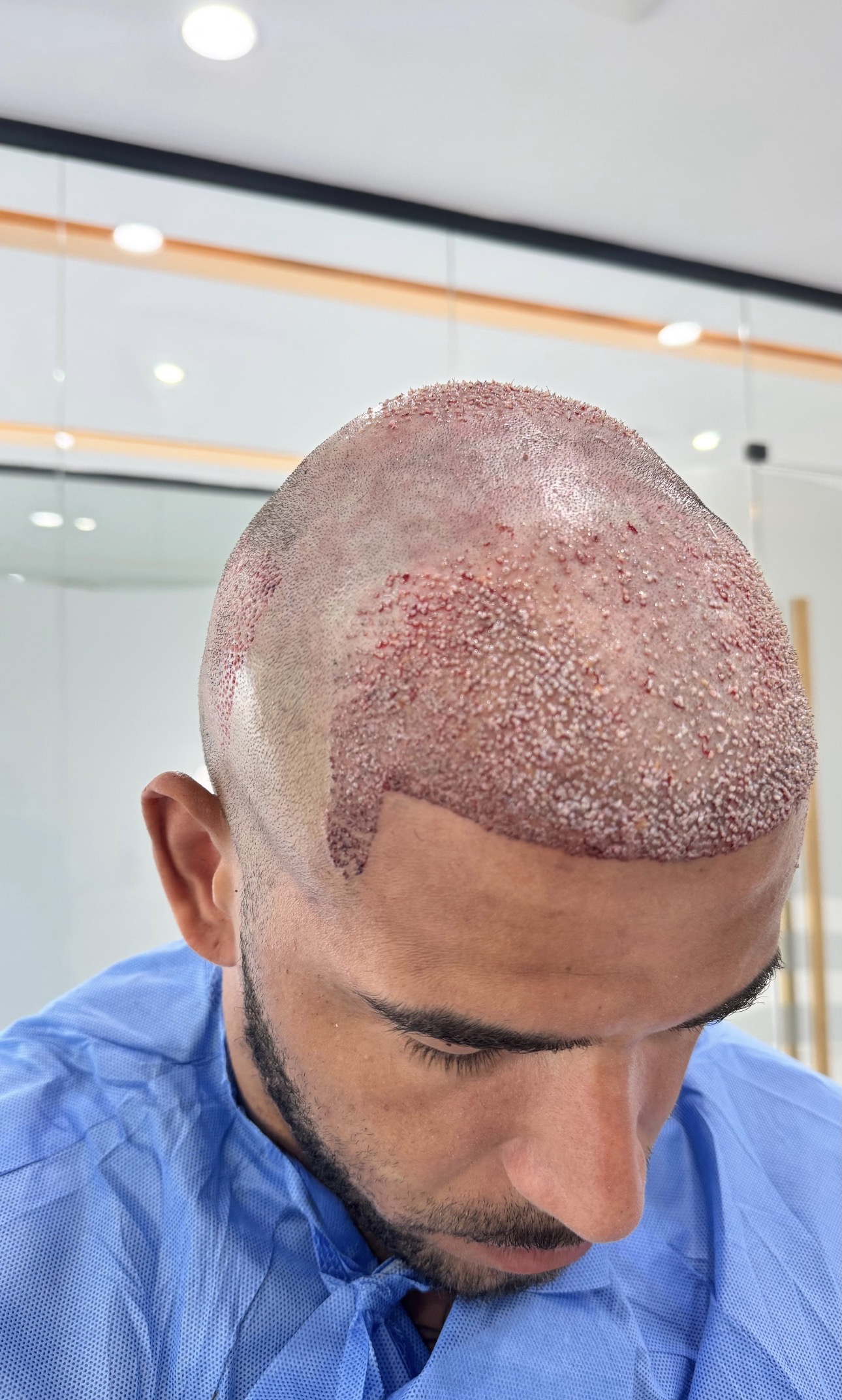 Afro пересадка волос в Анталье фото 14