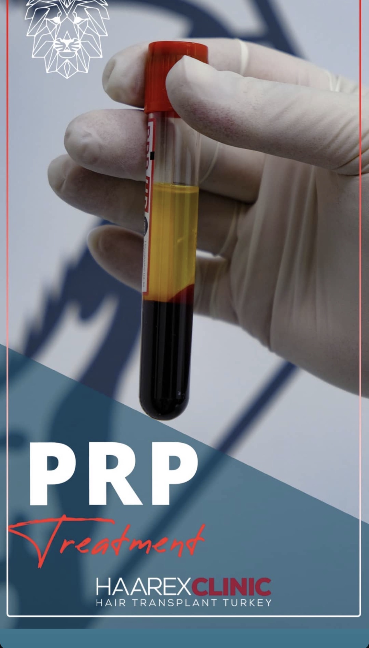 Haarex Clinic PRP-терапия при выпадении волос