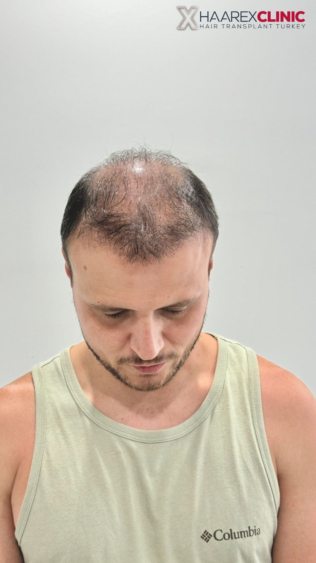 Пациент 4: до Sapphire FUE