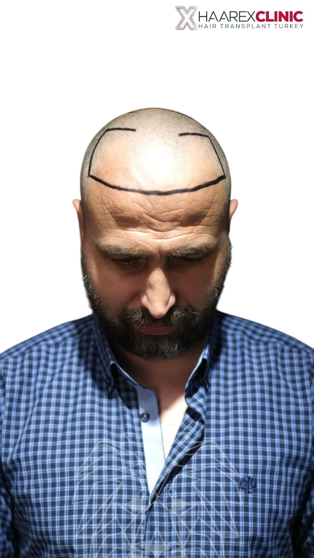 Пациент 2: вид после DHI