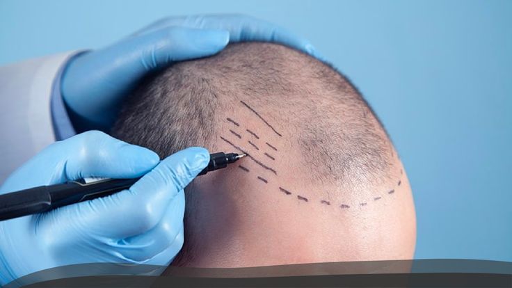 Гарантия на пересадку волос: что реально обещают клиники?