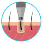 3. Punch insizyonu