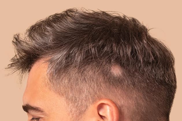 Saçkıran Nedir? Neden Olur?