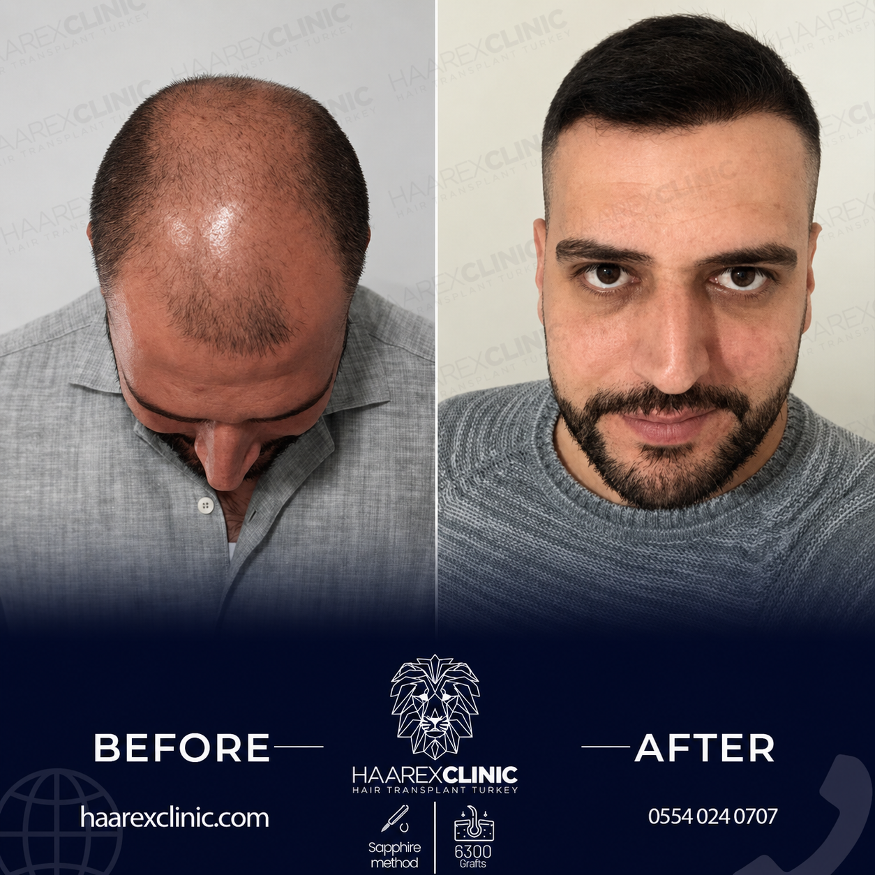 Hair transplant Antalya before and after result example three at Haarex Clinic