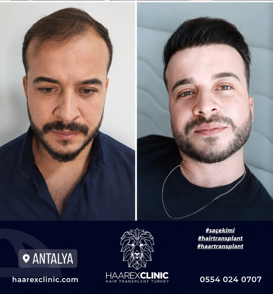 Hair transplant Antalya before and after result example six at Haarex Clinic