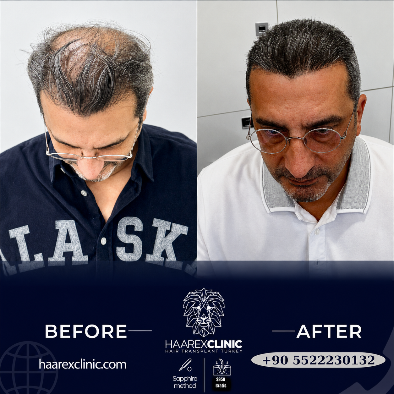 Hair transplant Antalya before and after result example five at Haarex Clinic