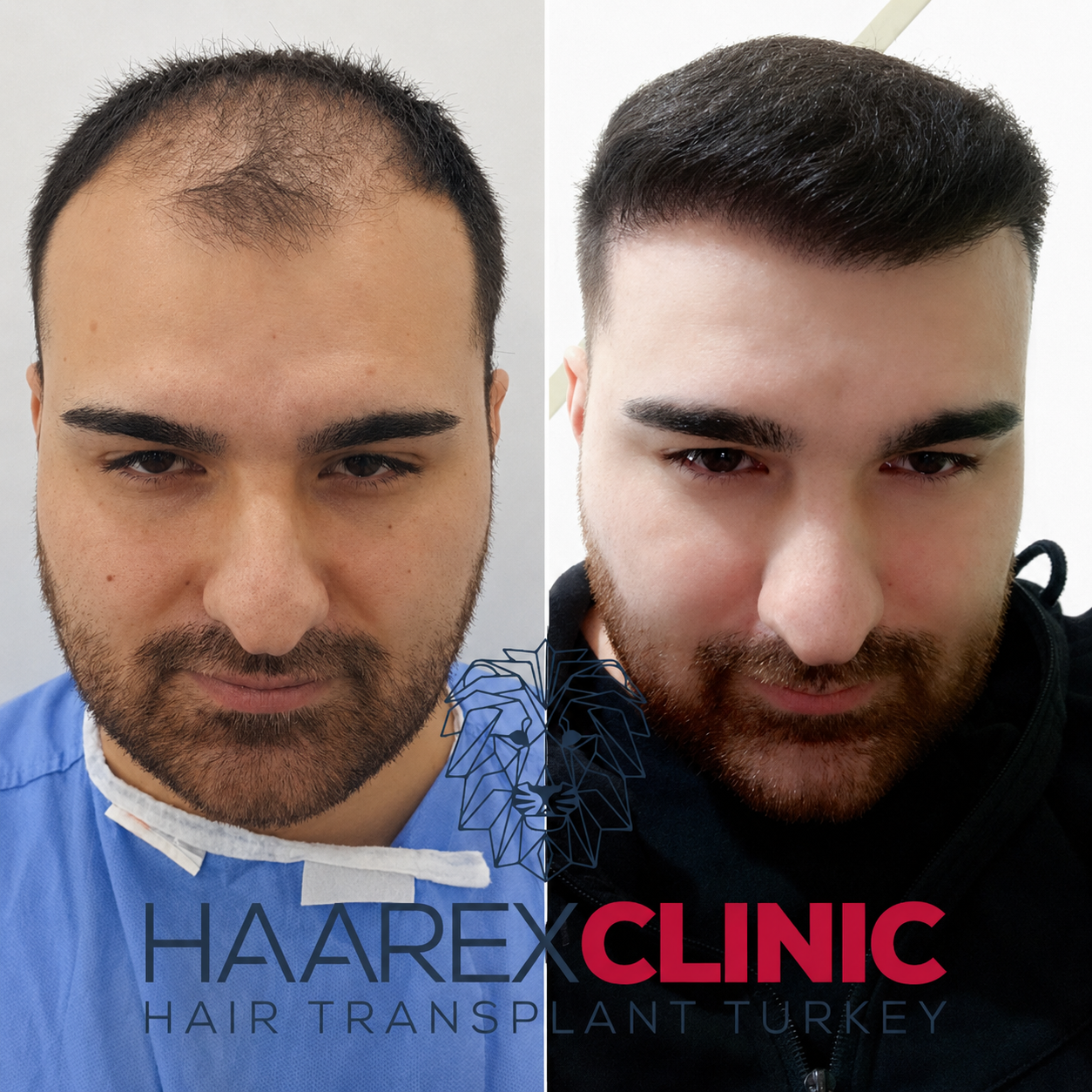 Hair transplant Antalya before and after result example one at Haarex Clinic