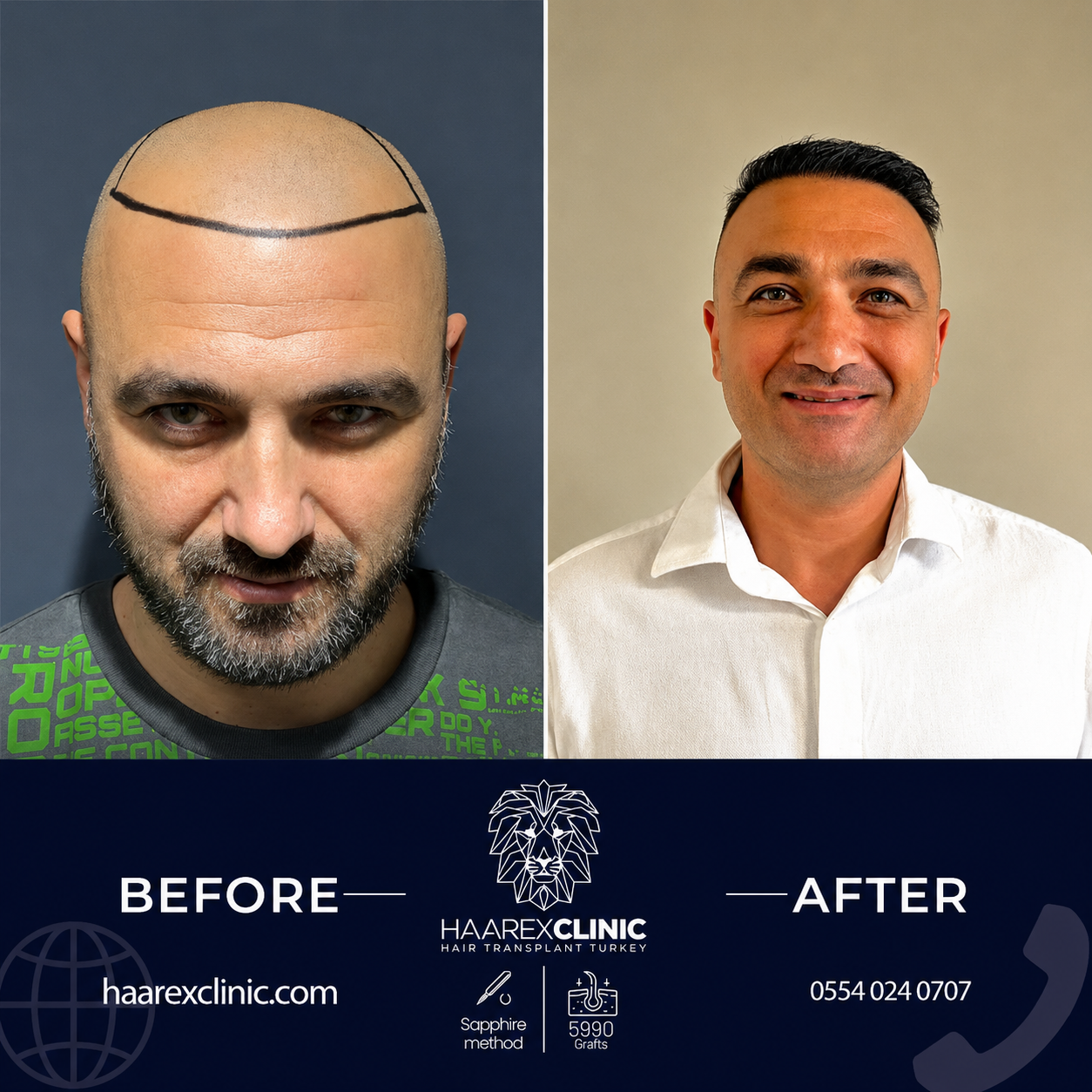 Hair transplant Antalya before and after result example four at Haarex Clinic