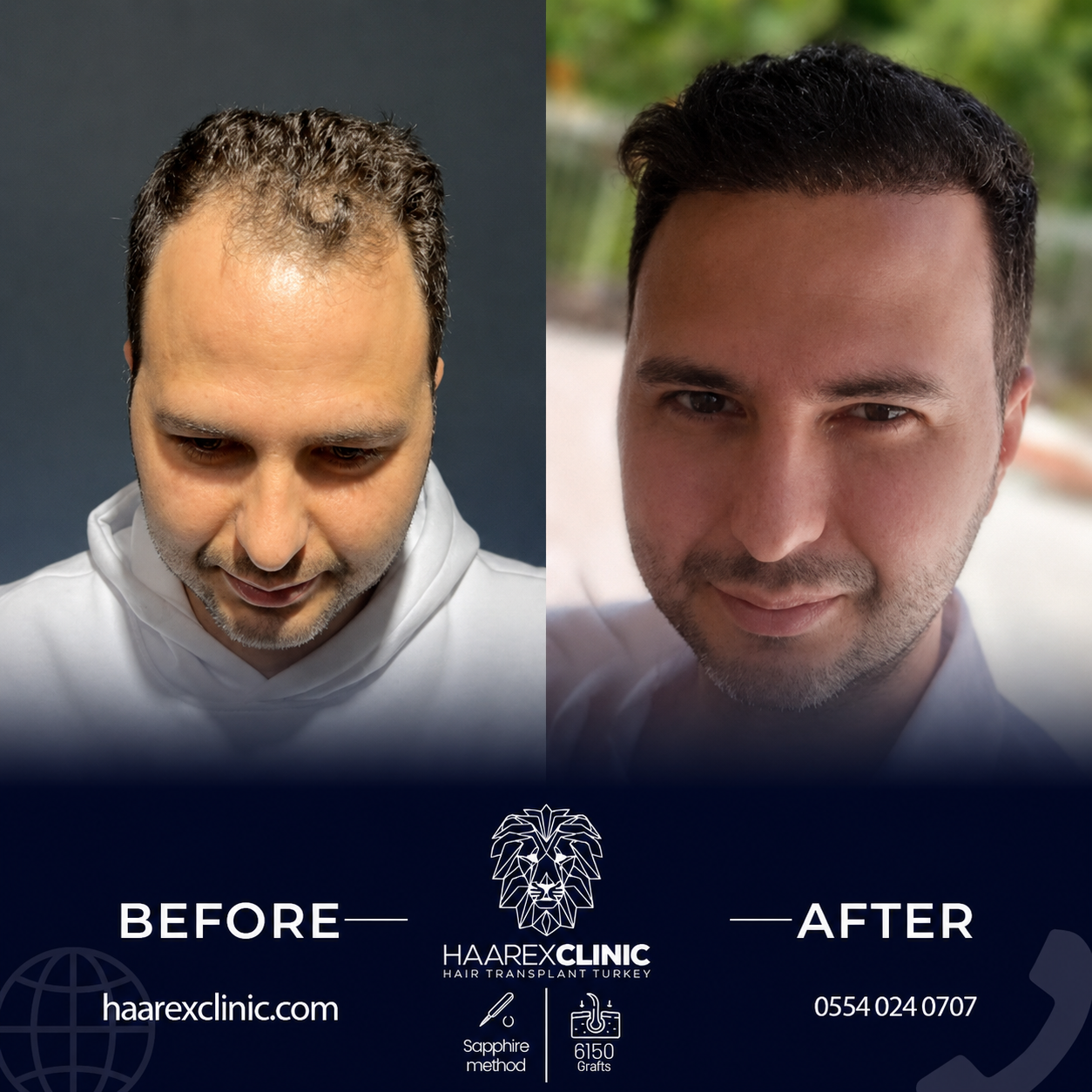 Hair transplant Antalya before and after result example two at Haarex Clinic