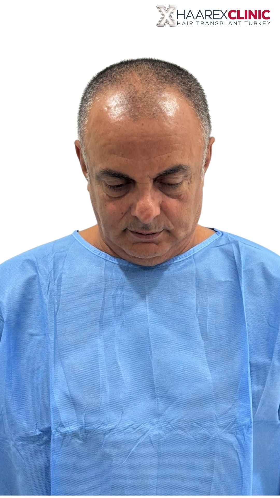 Hair transplant before result case two at Haarex Clinic Antalya