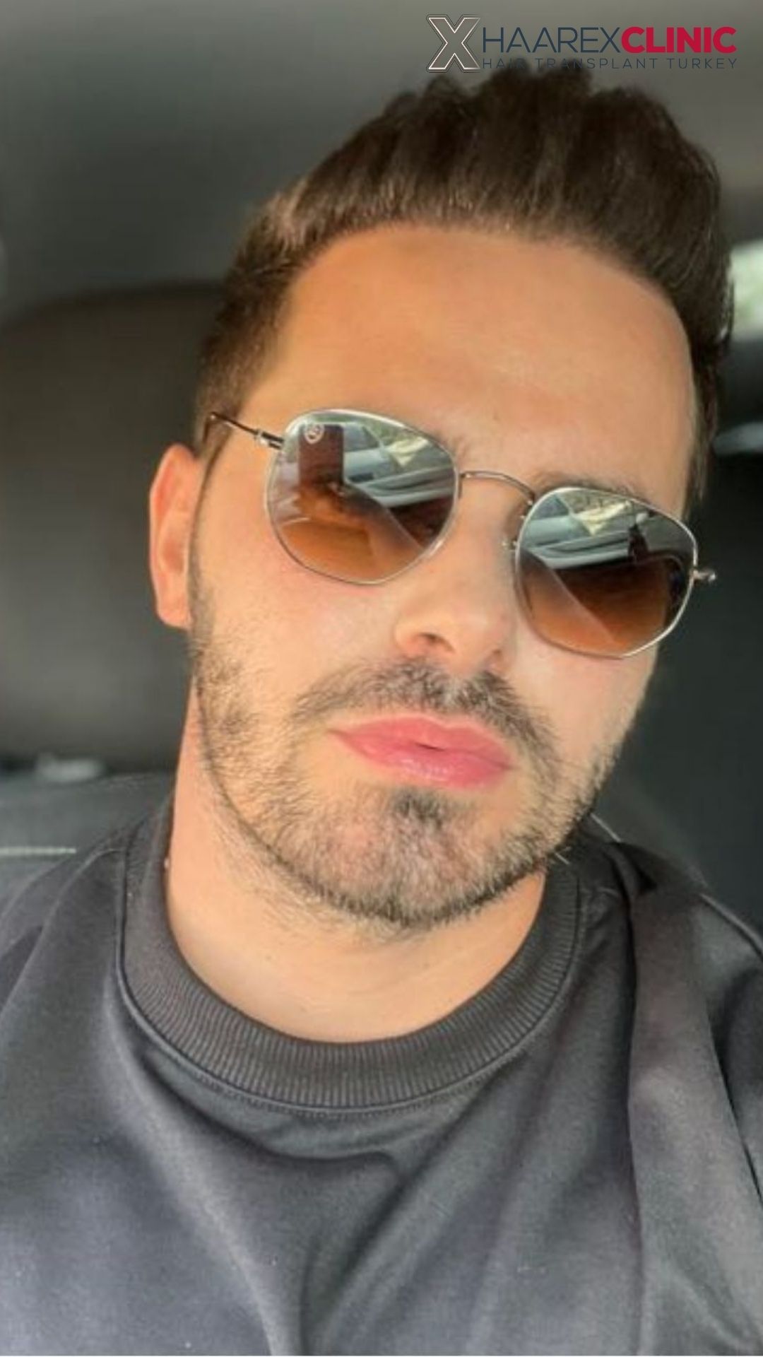Hair transplant after result case one at Haarex Clinic Antalya