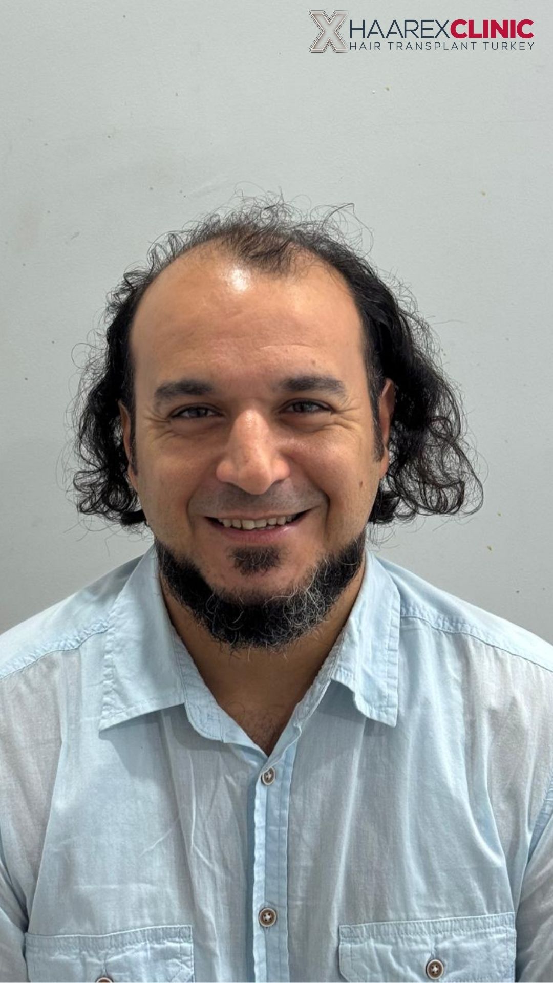 Hair transplant before result case three at Haarex Clinic Antalya