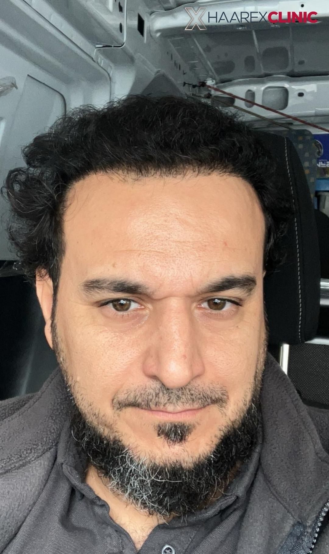 Hair transplant after result case three at Haarex Clinic Antalya