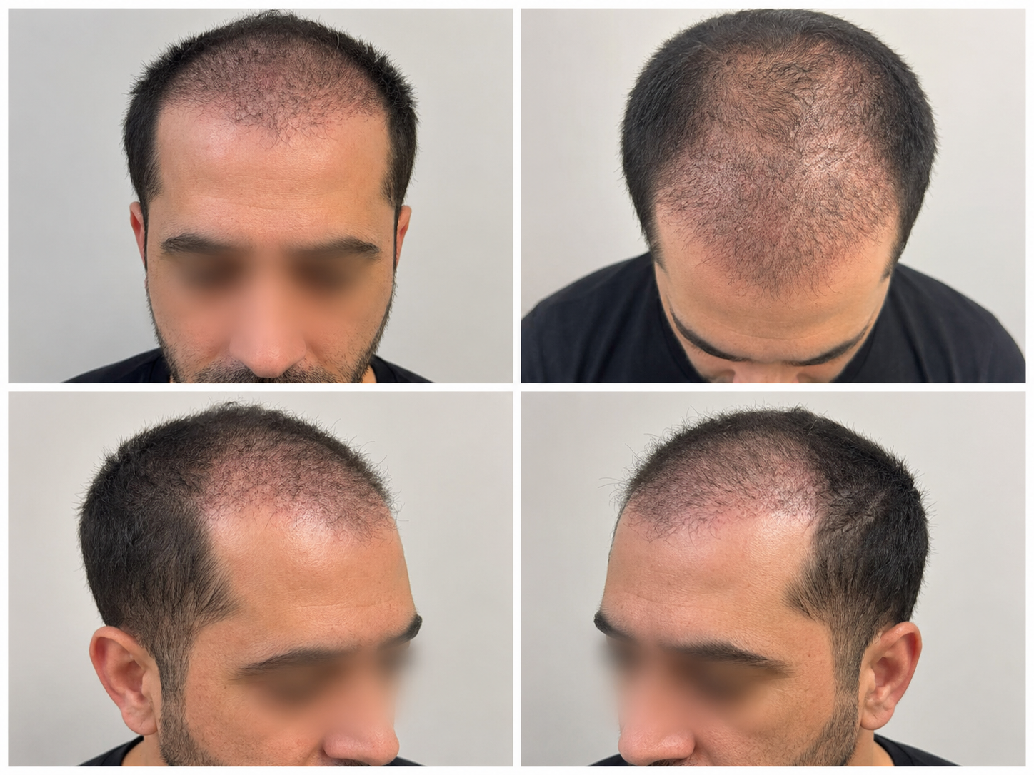 How Many Grafts Do I Need?