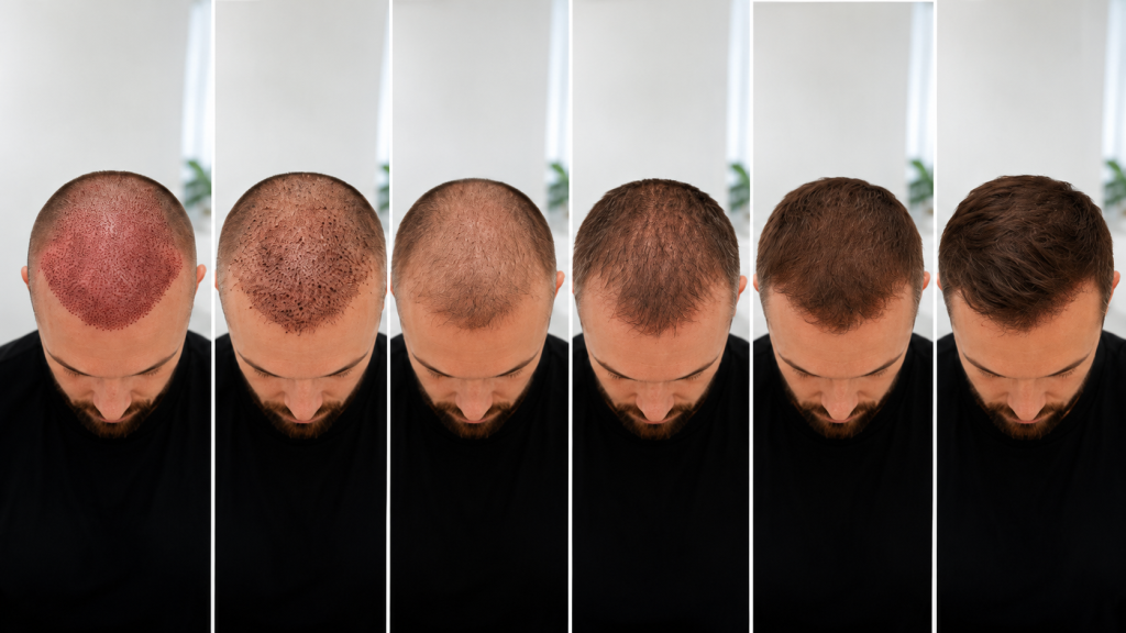Hair Transplant Recovery Timeline