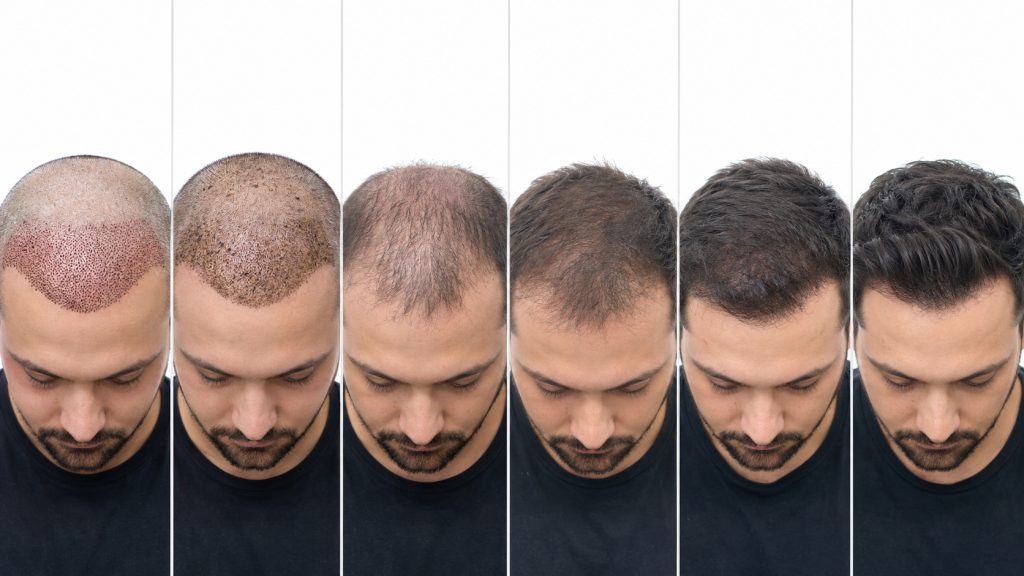 Hair Transplant Recovery Timeline
