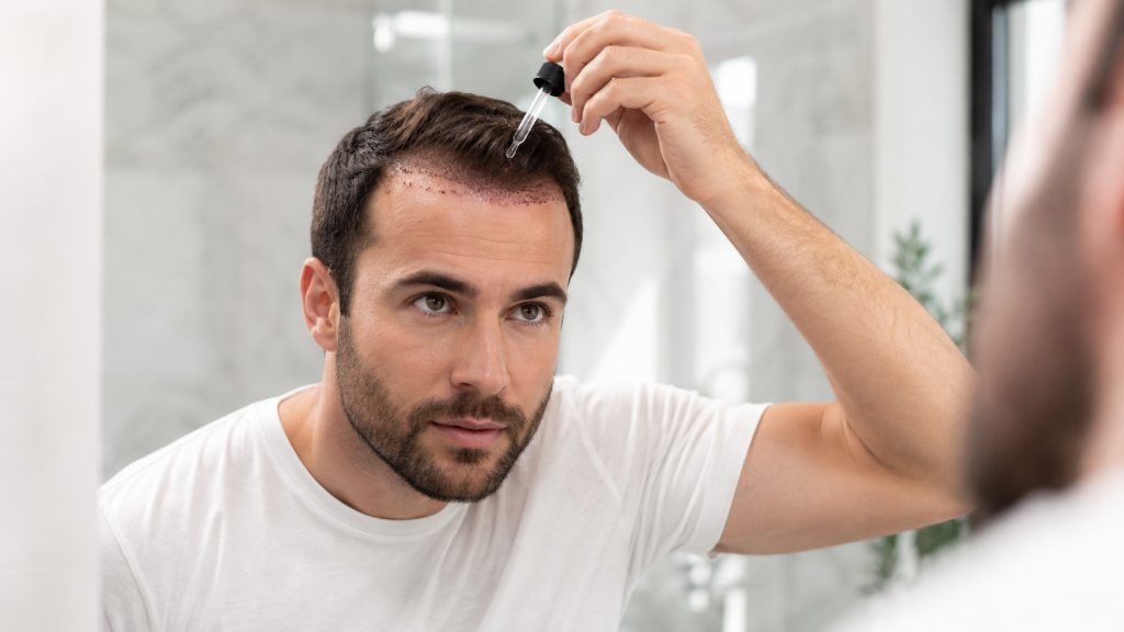 Minoxidil After Hair Transplant
