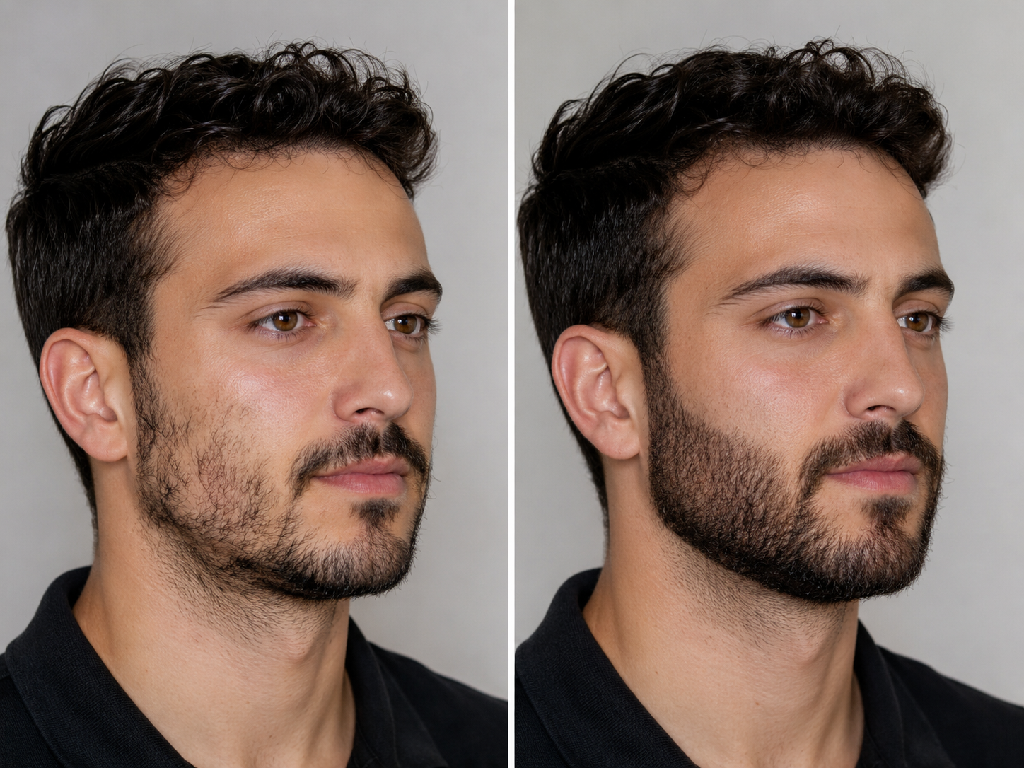 Beard and Mustache Transplant Results