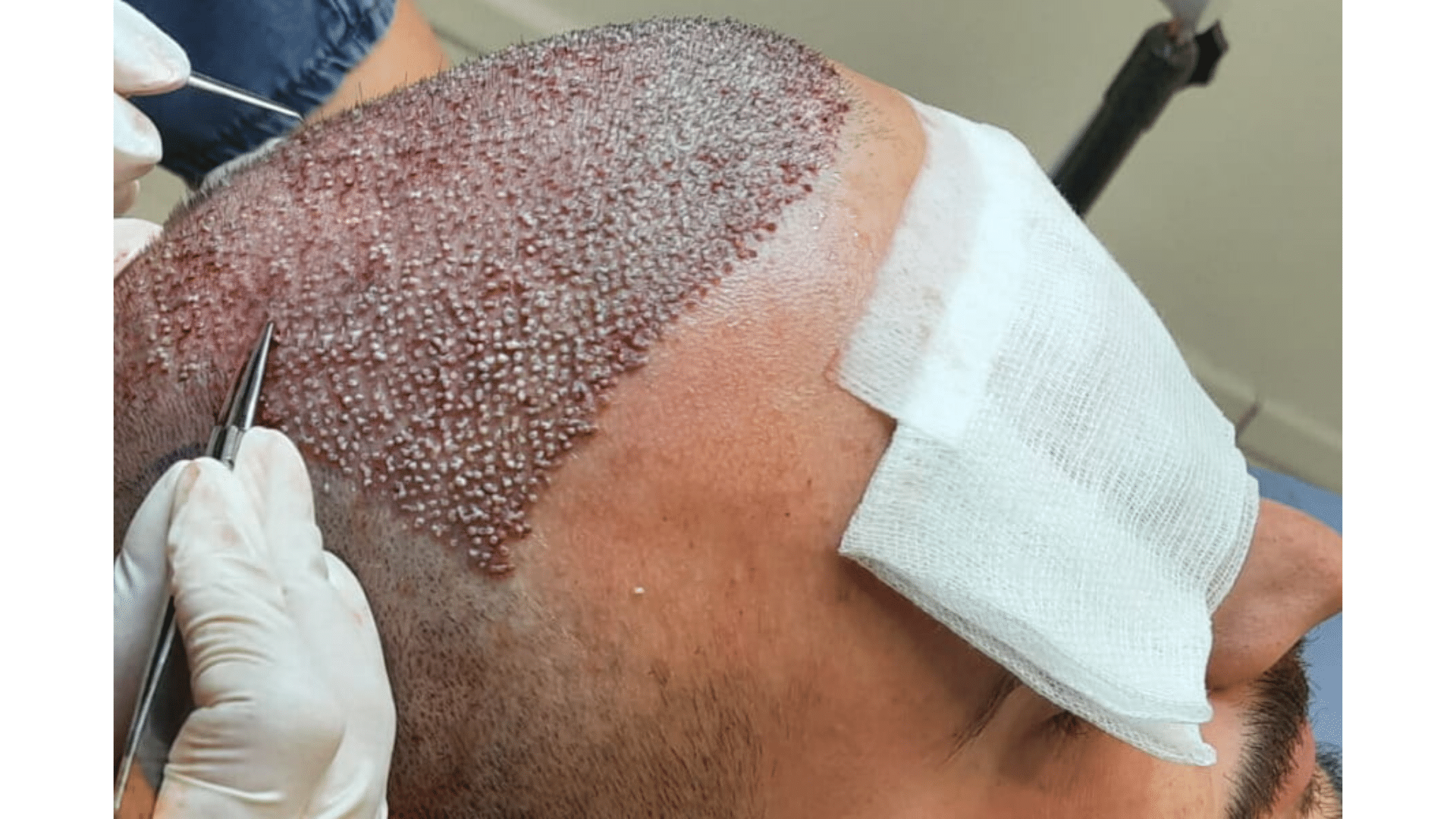 Does Hair Transplant Hurt? Pain Levels, Anesthesia, and What to Expect