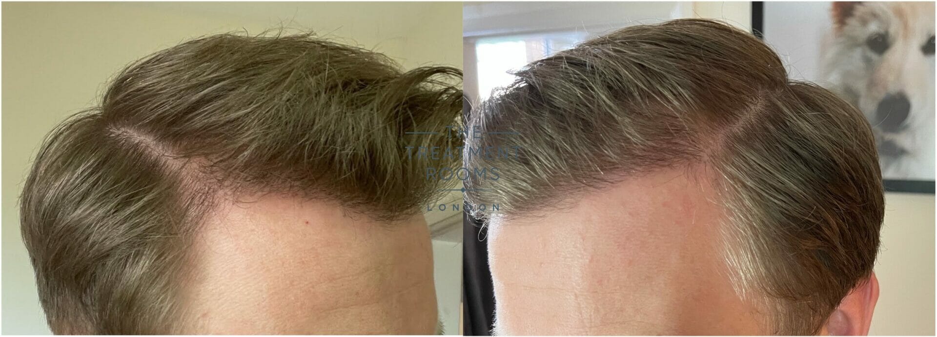 Hair Transplant After 6 Months: Growth, Results, and Expectations
