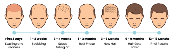 Hair Transplant Recovery: What Should You Pay Attention to in the First 30 Days?