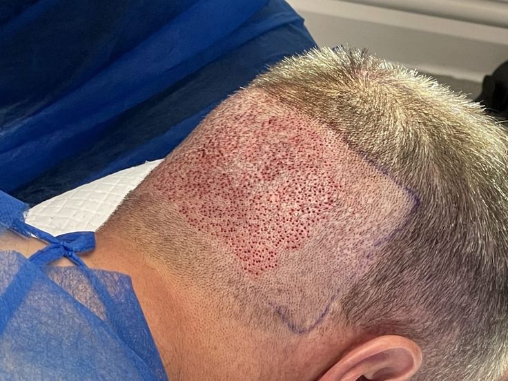 Hair Transplant Recovery: What Should You Pay Attention to in the First 30 Days?