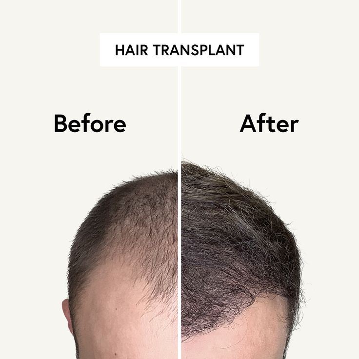Hair Transplant Spain vs Turkey: Costs, Results & What You Should Know