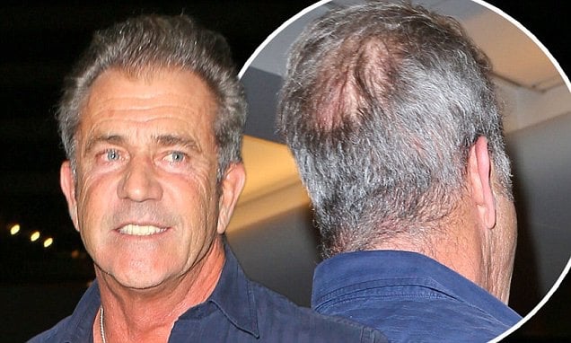 Mel Gibson Hair Transplant: Did the Hollywood Icon Really Have One?