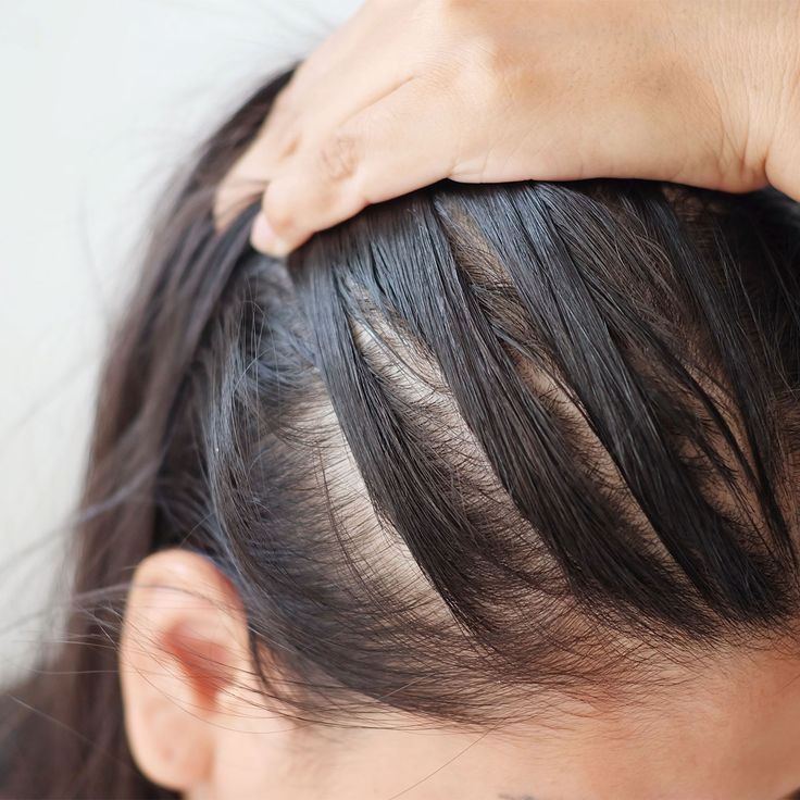 My Hair Is So Thin I Can See My Scalp – What Should I Do?