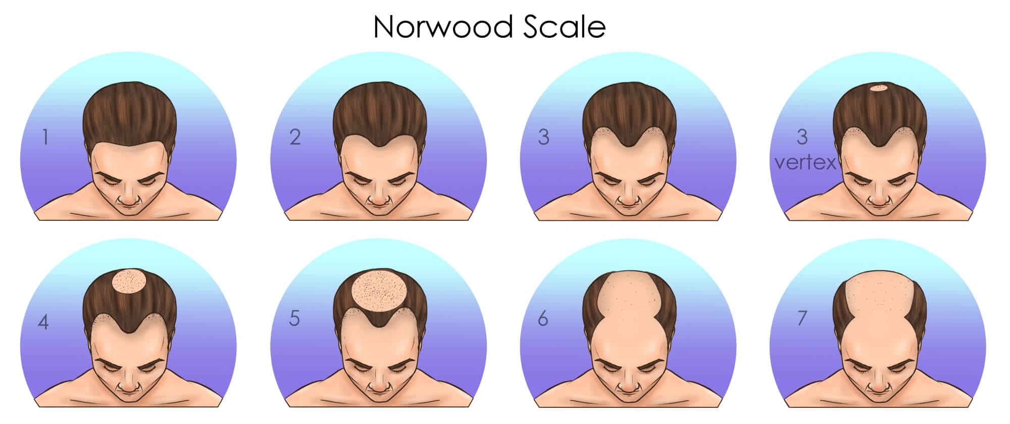Norwood Scale (Stages 1–7): What Can You Do at Each Stage?
