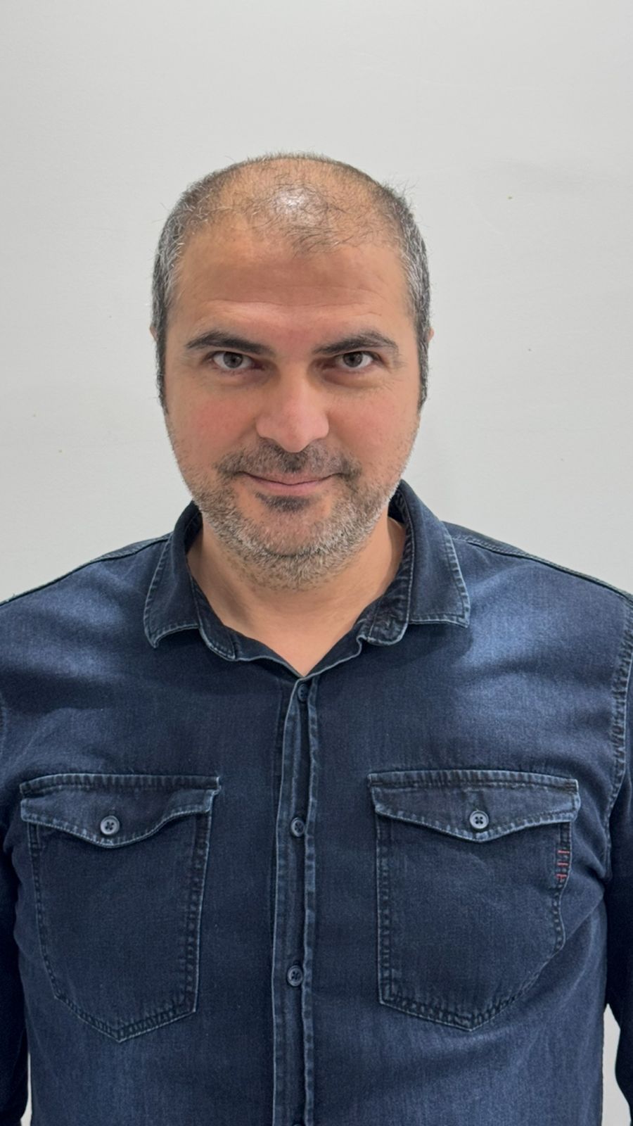 Hair Transplant in Antalya Before and After Results