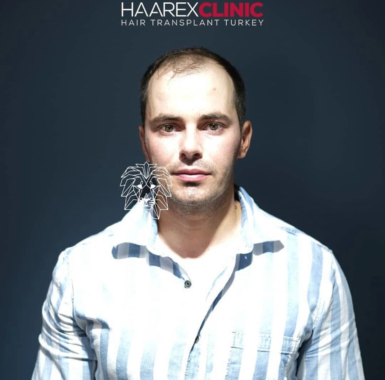 Christian’s Hair Transplant in Turkey – Before and After