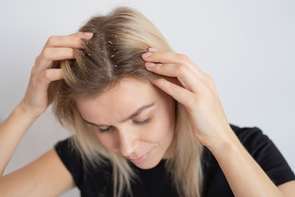 Seborrheic Dermatitis and Hair Loss: Causes, Treatment, and Regrowth